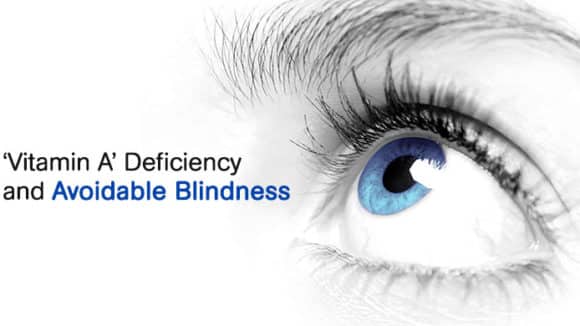 ‘Vitamin A’ Deficiency and Avoidable Blindness