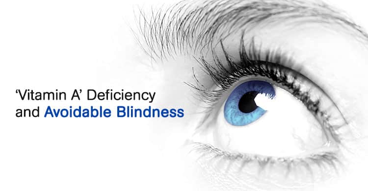 ‘Vitamin A’ Deficiency and Avoidable Blindness